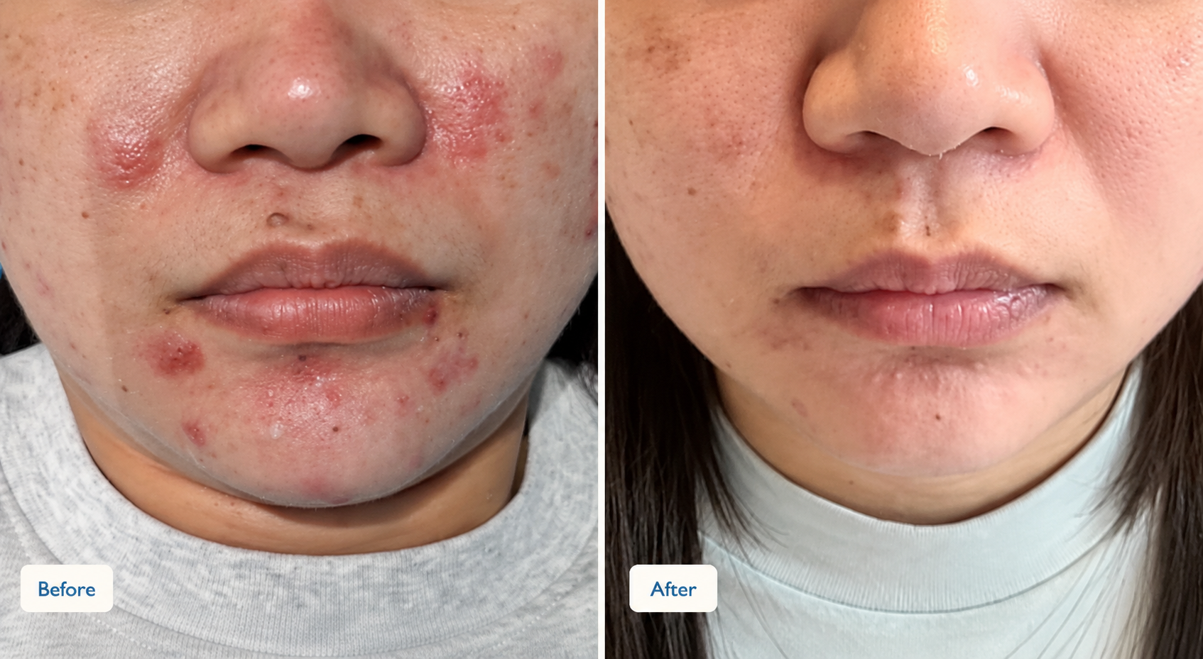 AI-enhanced lower-face acne comparison; before left and after right