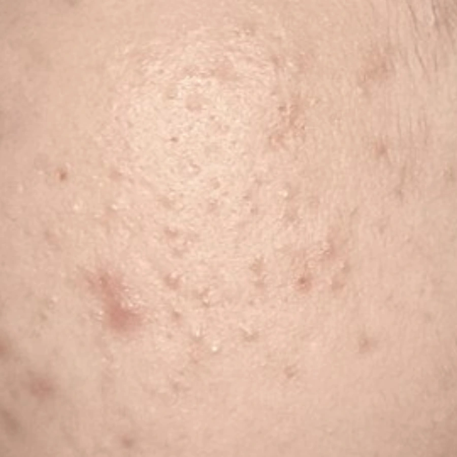After: Acne — cheek