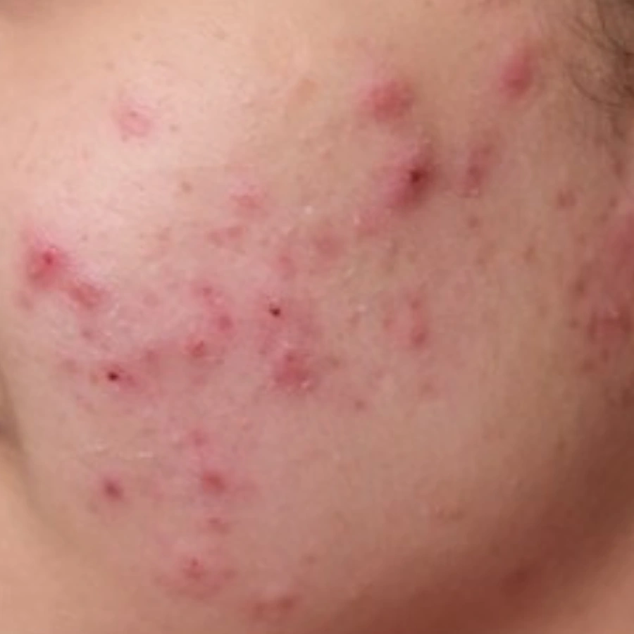 Before: Acne — cheek
