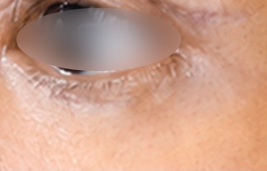 After: Blepharoplasty
