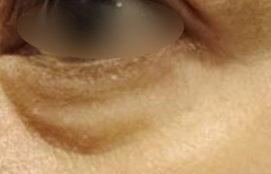 Before: Blepharoplasty