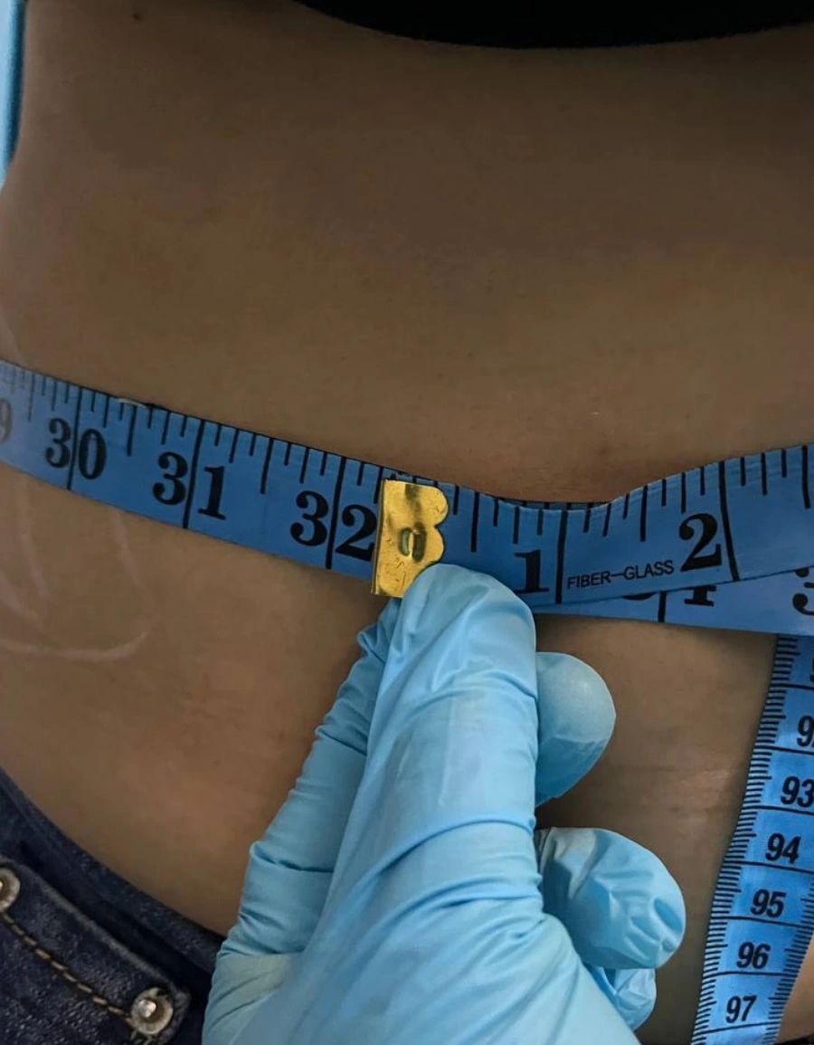 After: Abdomen