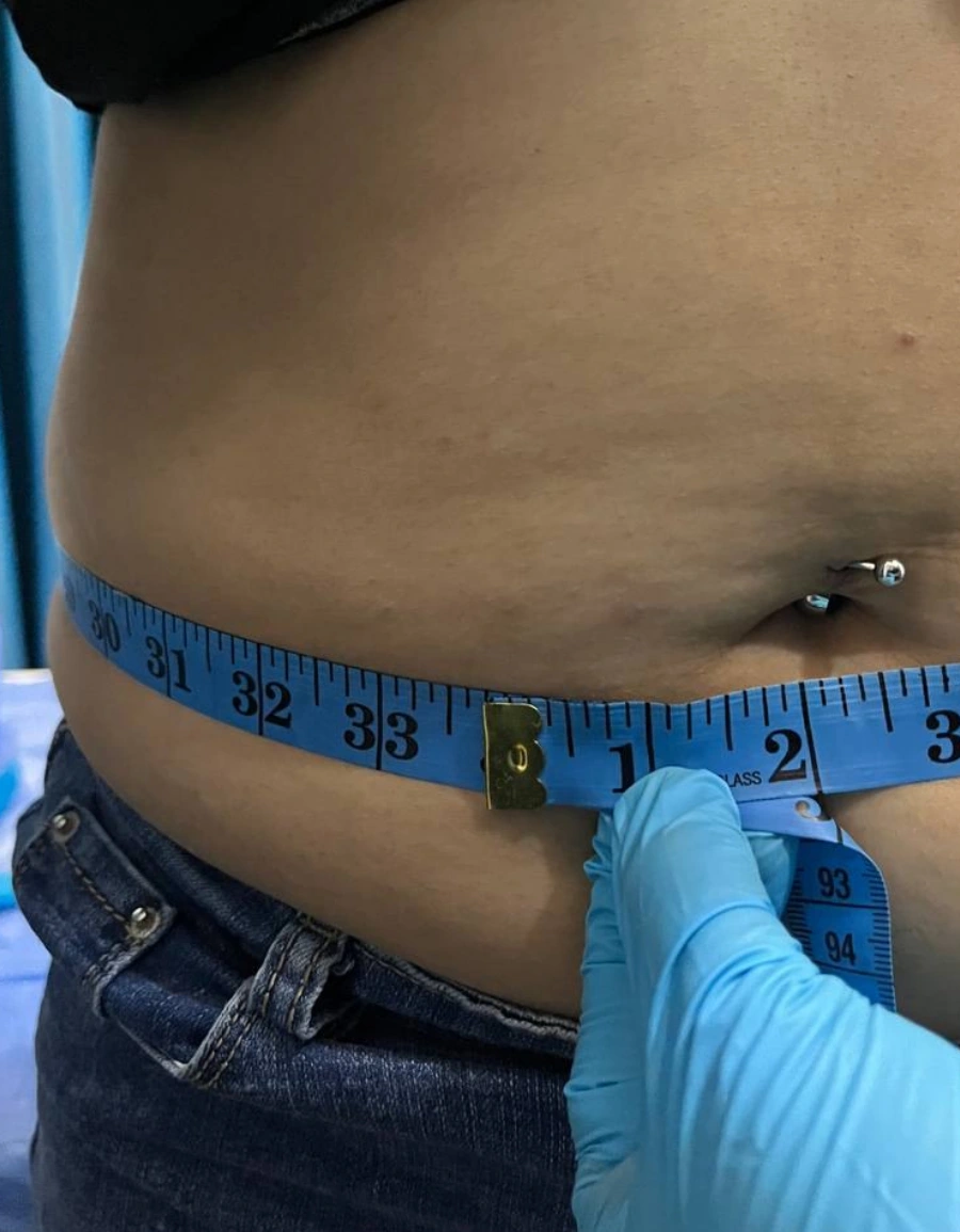 Before: Abdomen