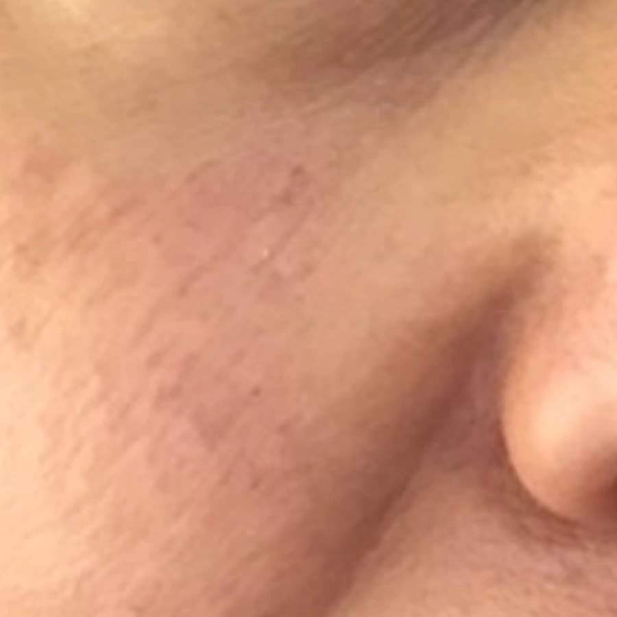 After: Cheek texture