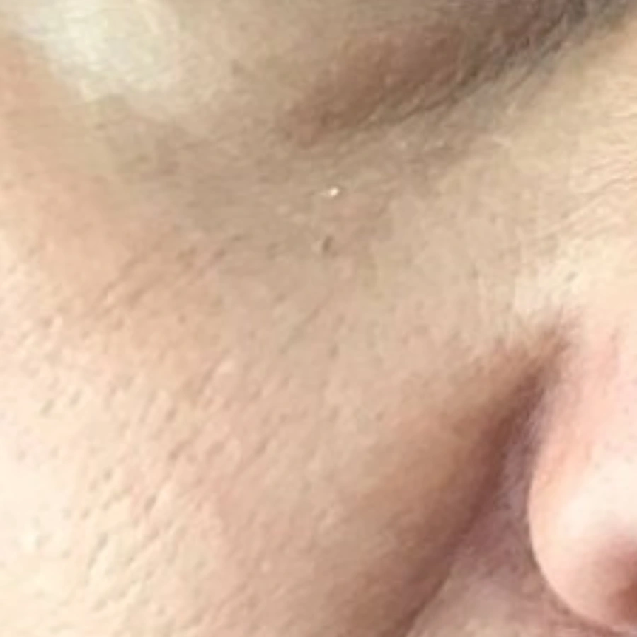 Before: Cheek texture