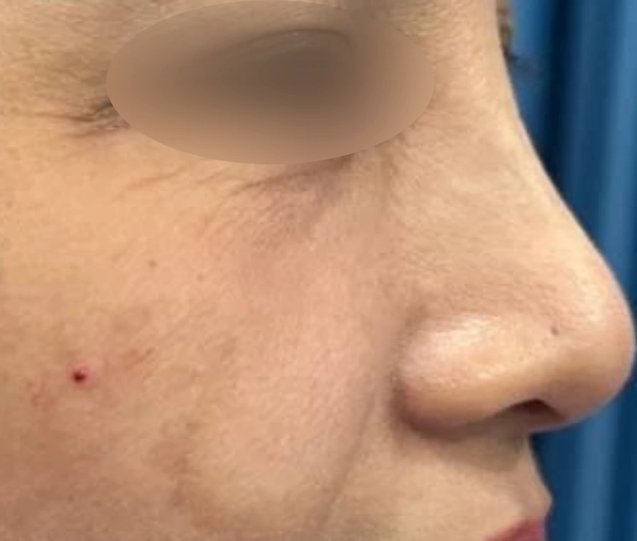 After: Under-eye area