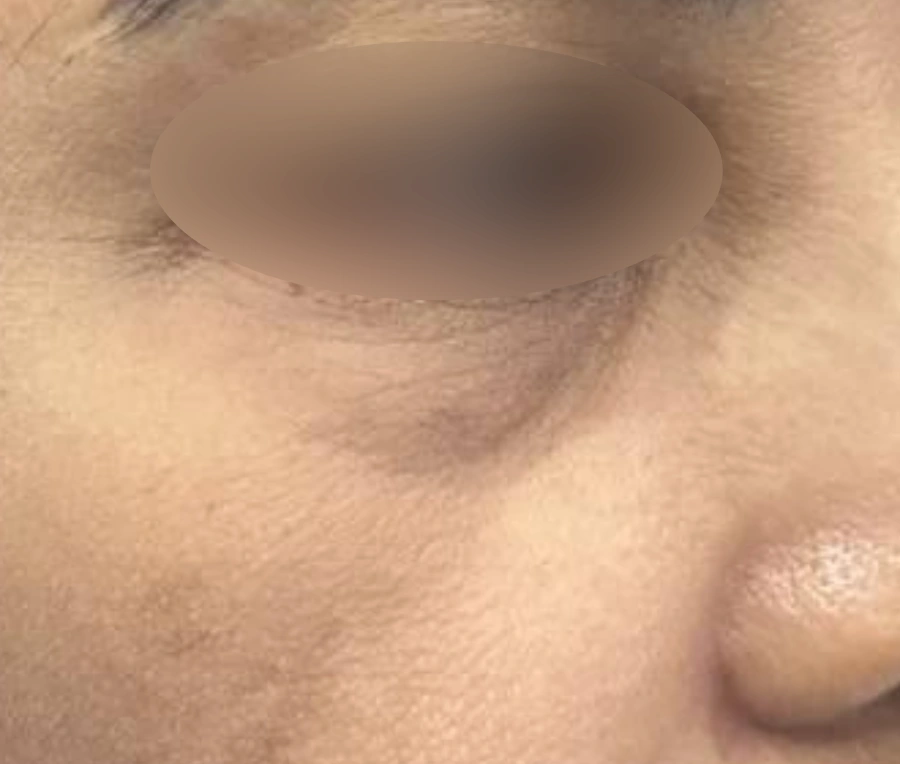 Before: Under-eye area