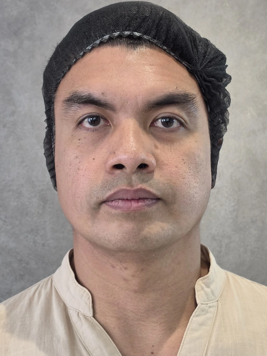 Before: Skin texture