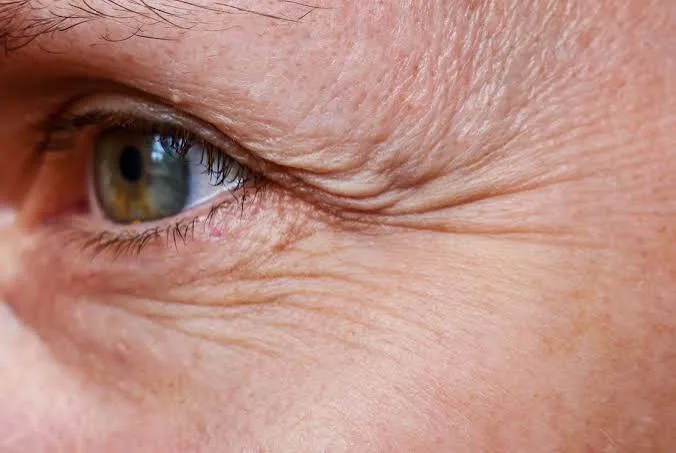 Wrinkles concern reference