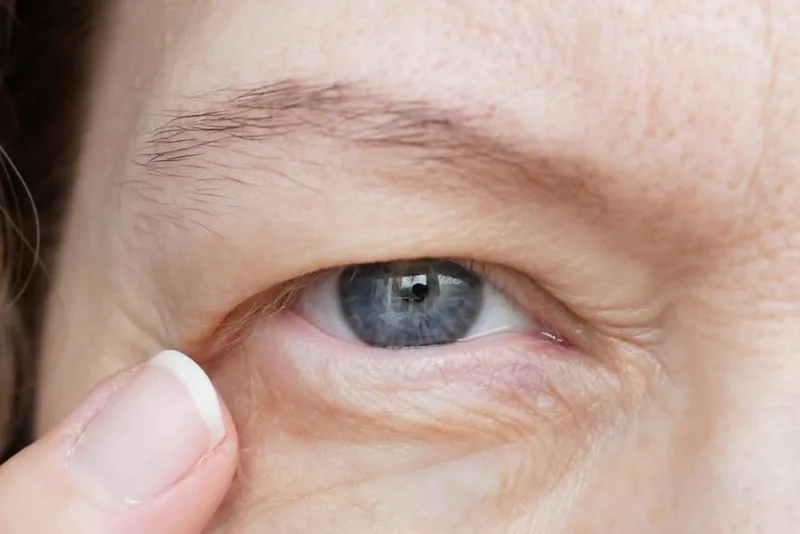 Hooded Eyelids concern reference
