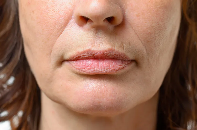 Drooping Cheeks concern reference