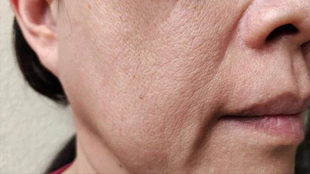 Nasolabial Folds concern reference