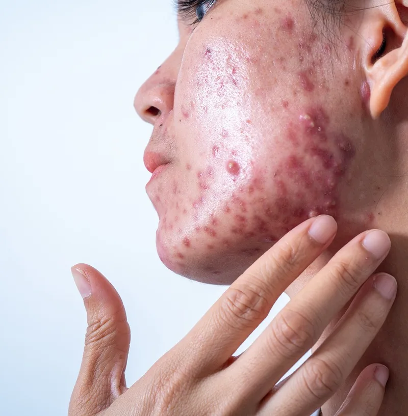 Acne concern reference