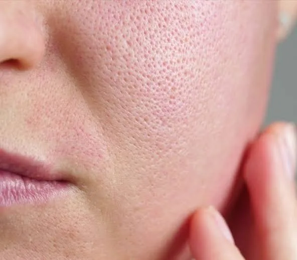 Enlarged Pores concern reference