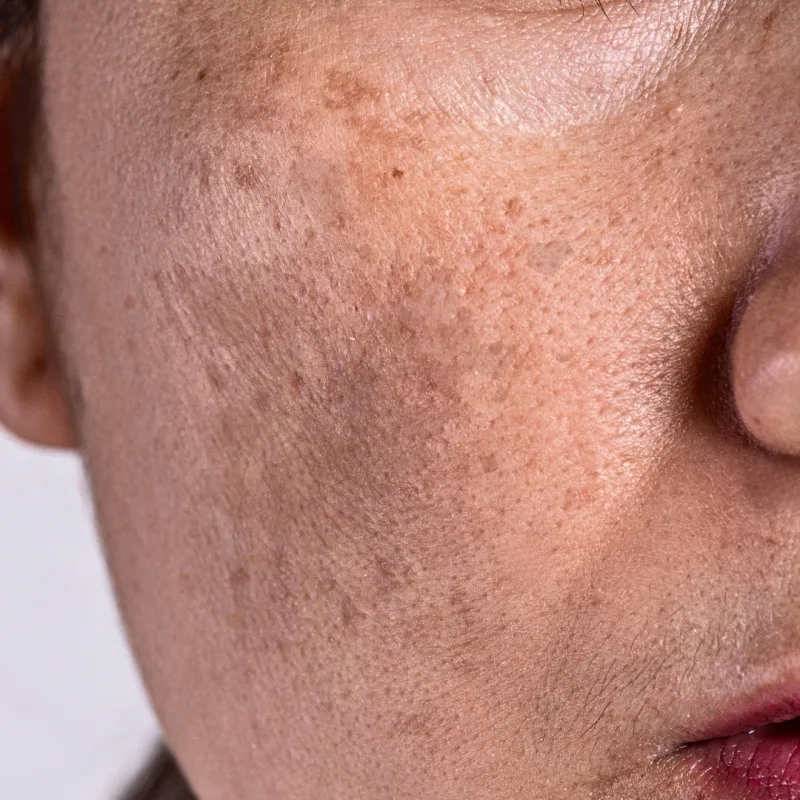 Pigmentation concern reference