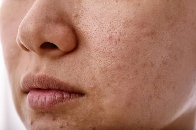 Dull Skin concern reference