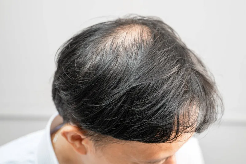 Hair Loss concern reference