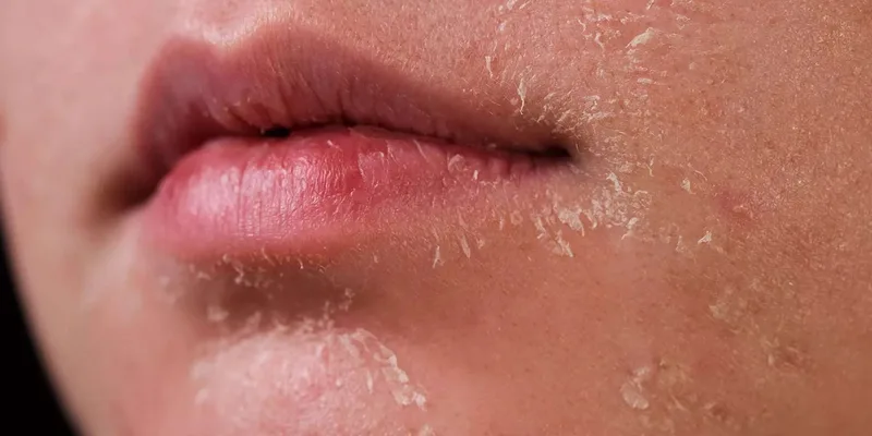 Dry Skin concern reference
