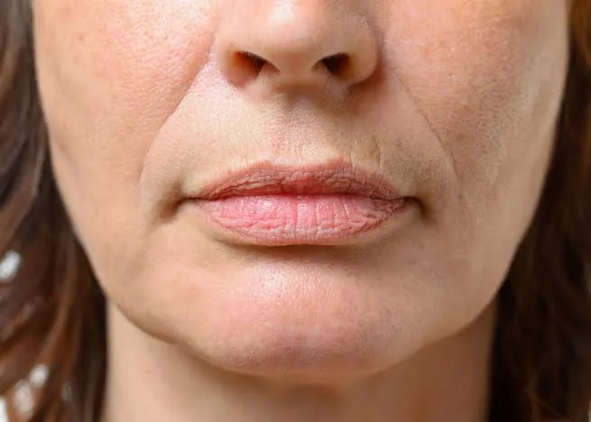 Fillers concern reference