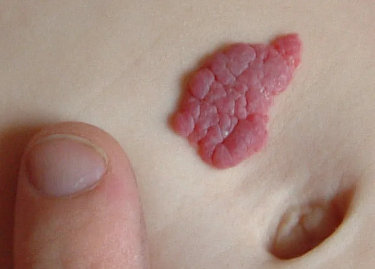 Hemangioma concern reference