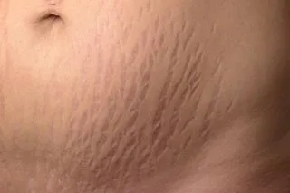 Stretchmark concern reference
