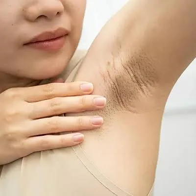 Dark Underarms concern reference