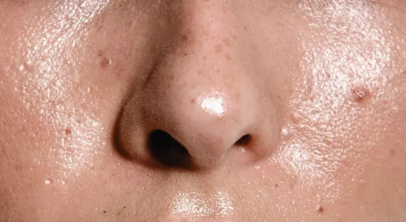 Oily Skin concern reference