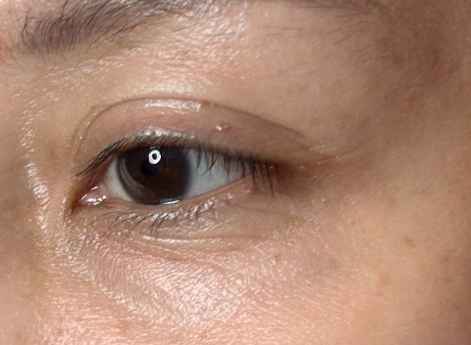 After: supplied eye-area photograph