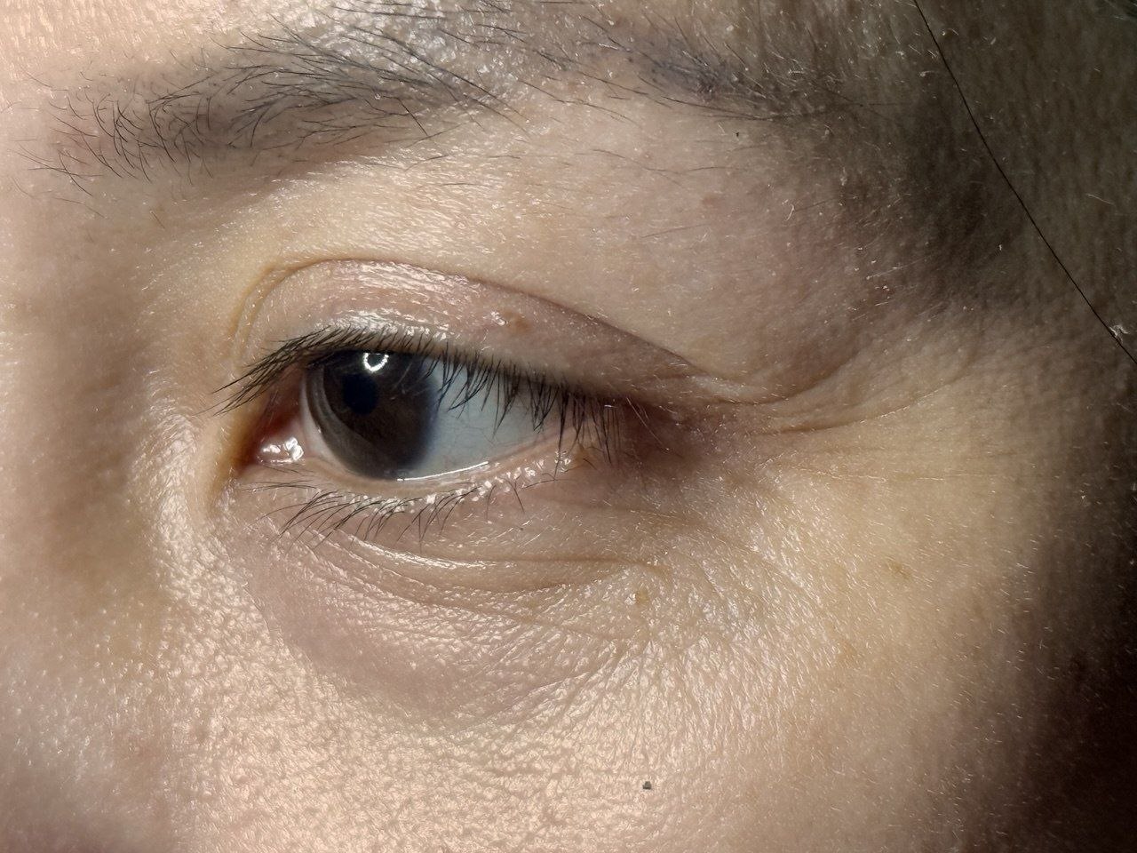 Before: supplied eye-area photograph