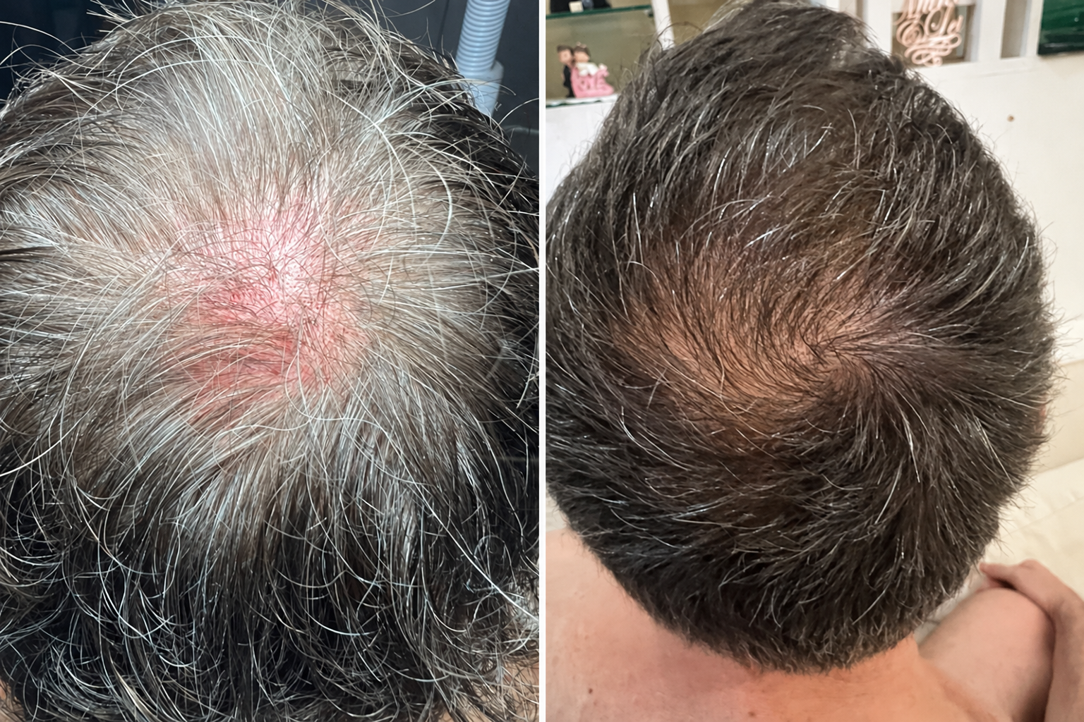 Supplied hair therapy comparison, AI-enhanced for clarity; before left, after right