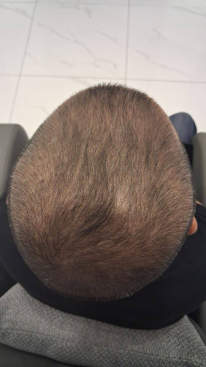 After: original crown and scalp photograph