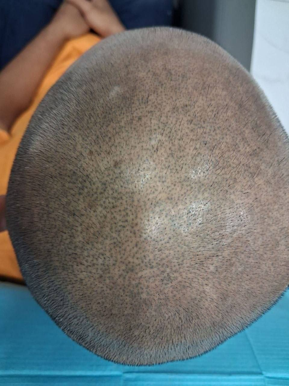 Before: original crown and scalp photograph