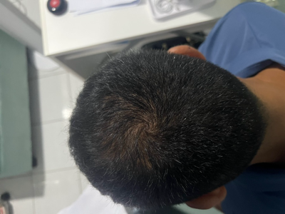 After hair therapy: original crown and scalp photograph