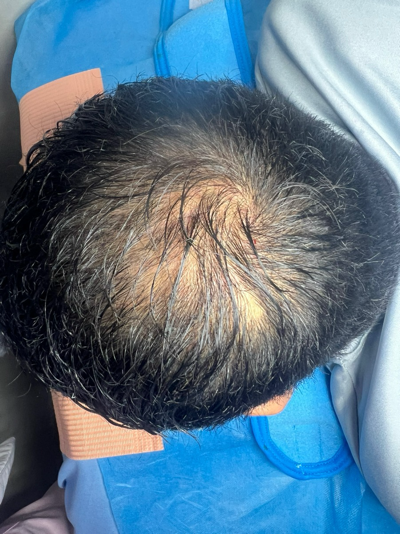 Before hair therapy: original crown and scalp photograph