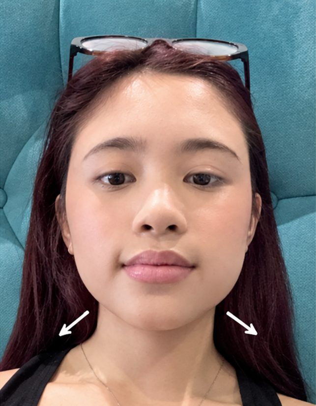 Before Jawtox, full face; AI-enhanced preview