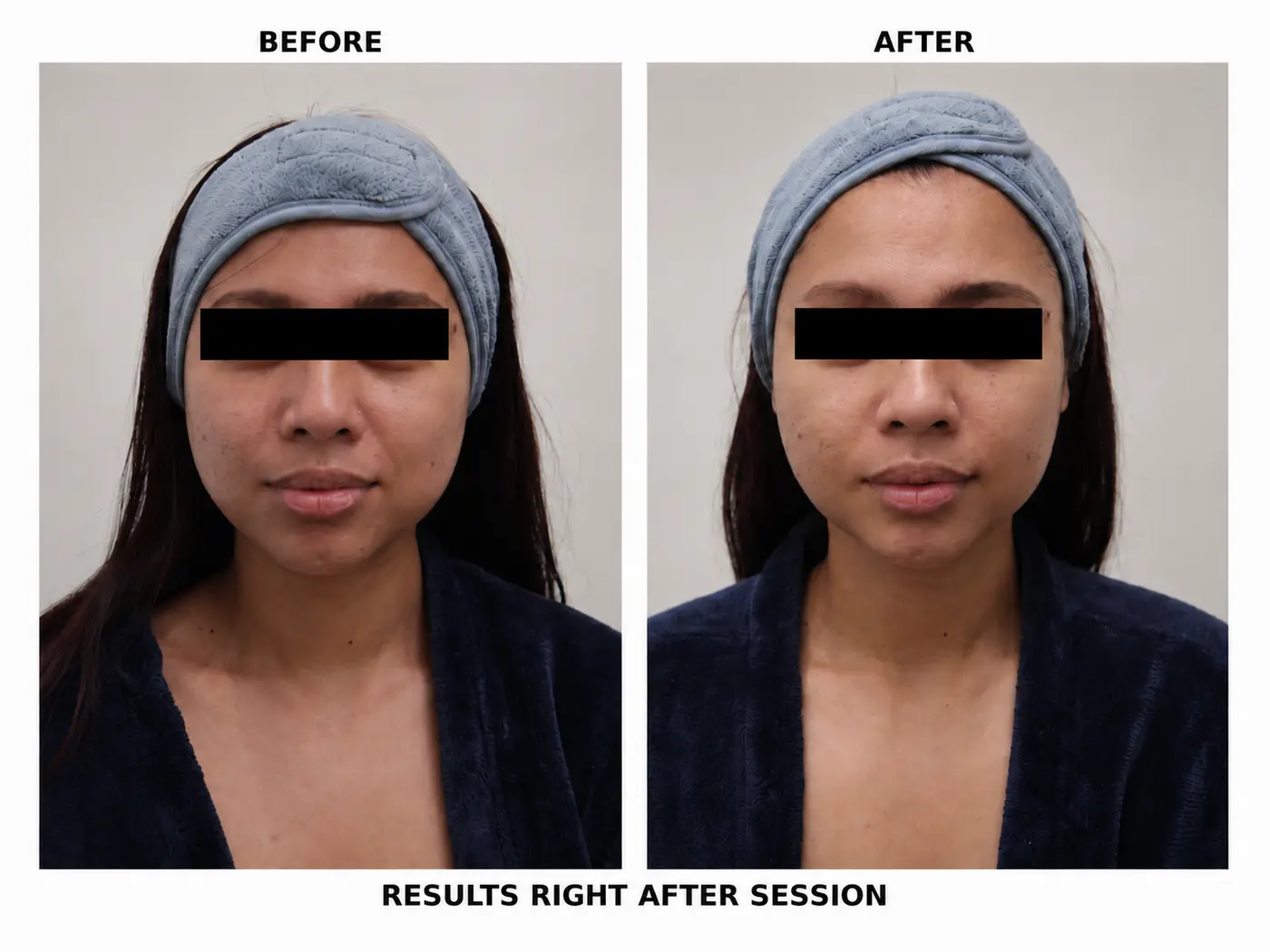 Before and after reference for a Byootee 10Therma treatment plan