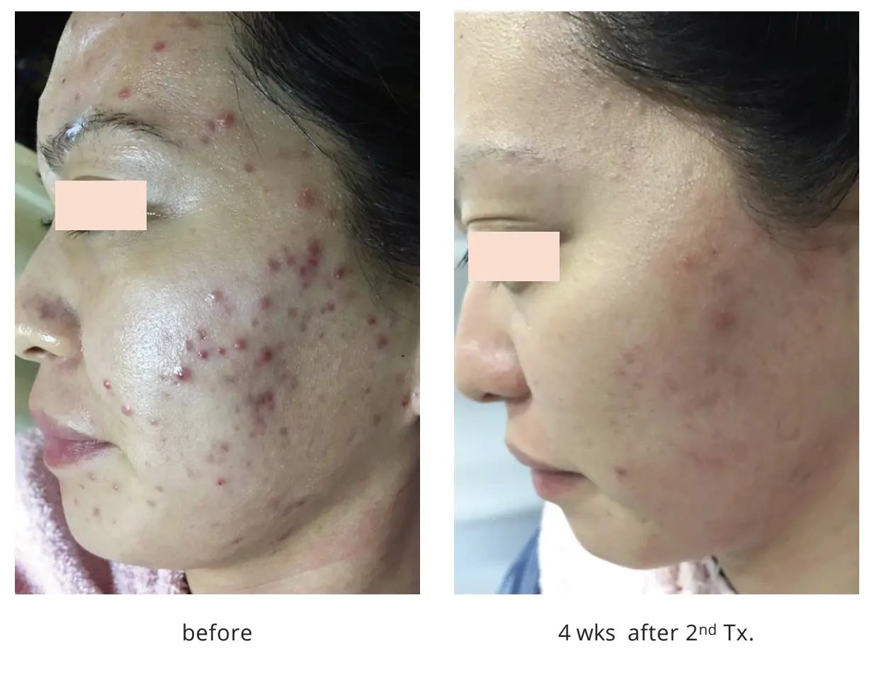 Before and after reference for a Byootee Agnes RF treatment plan
