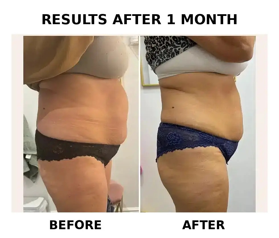 Before and after reference for a Byootee Aqualyx treatment plan