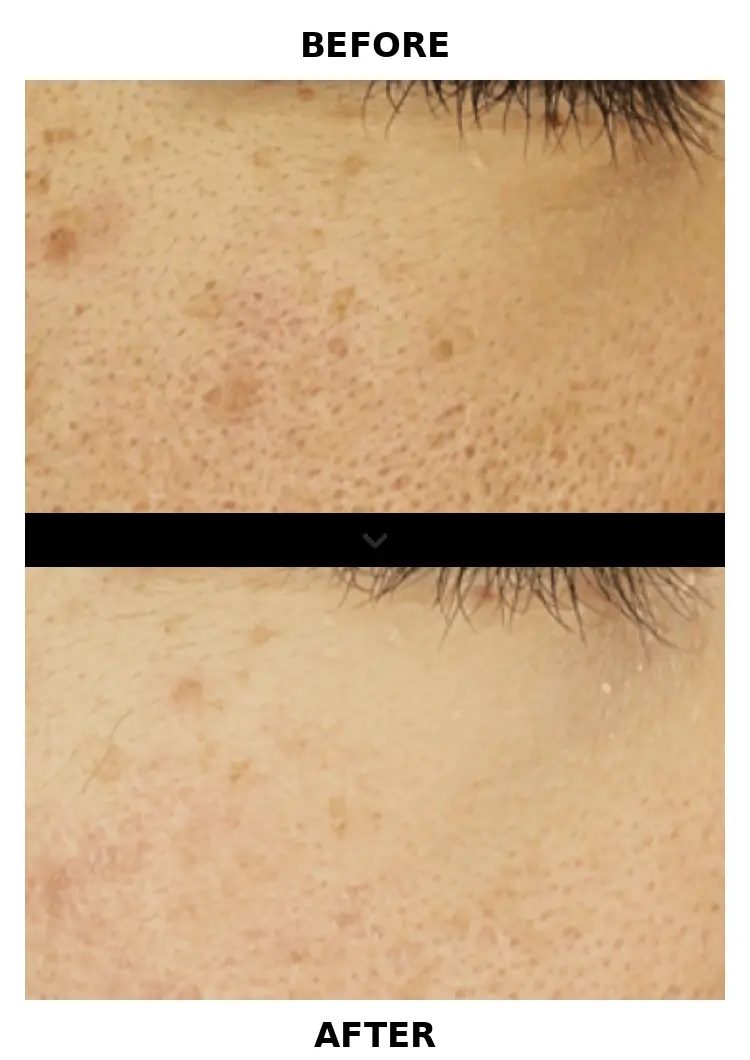Before and after reference for a Byootee CureJet treatment plan