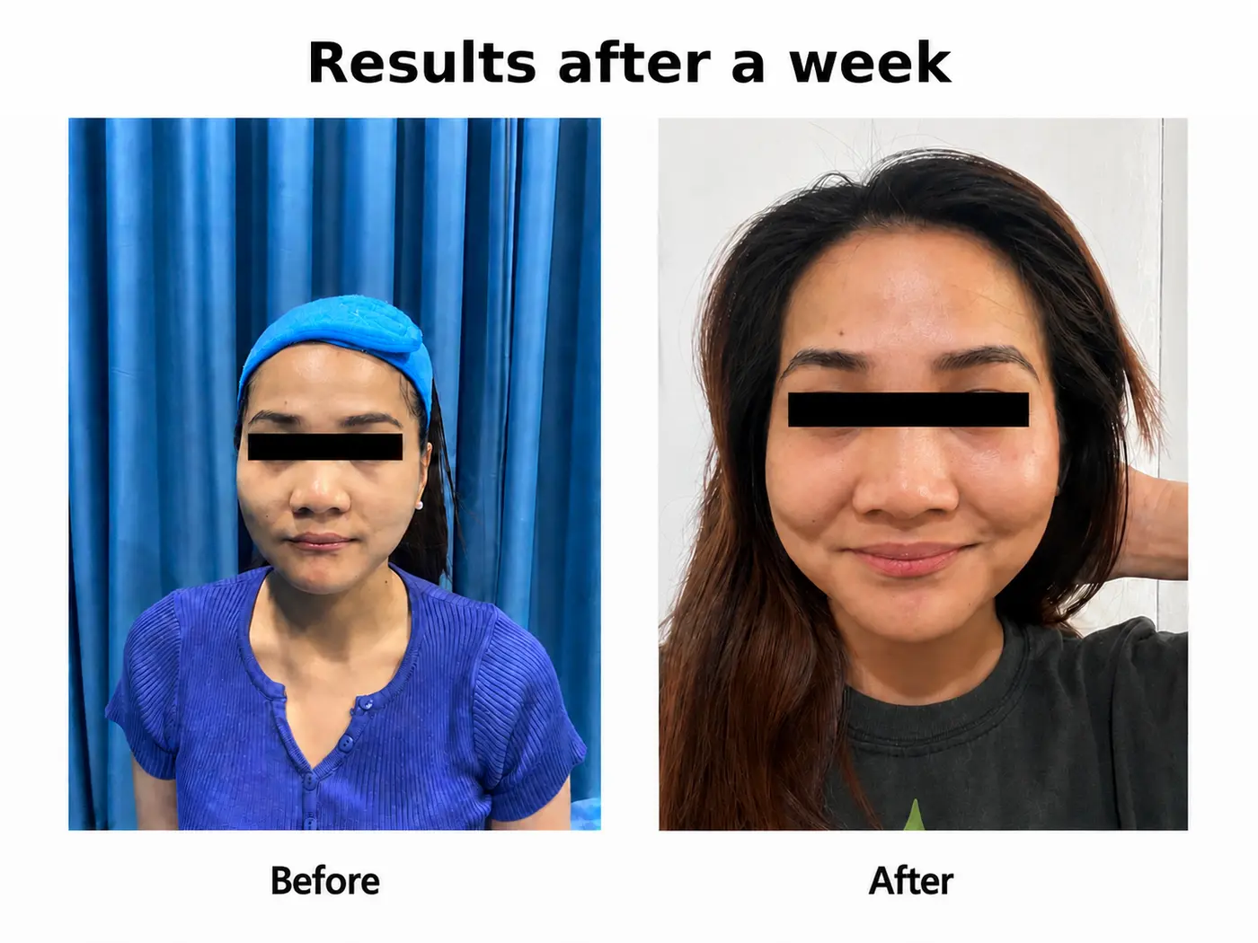 Before and after reference for a Byootee Juvelook treatment plan