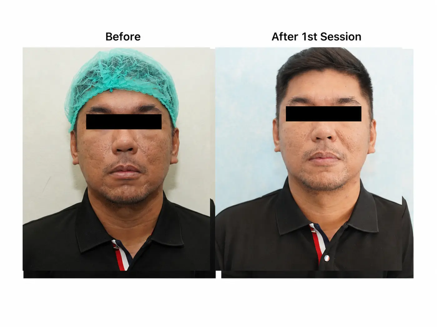 Before and after reference for a Byootee Lenisna treatment plan