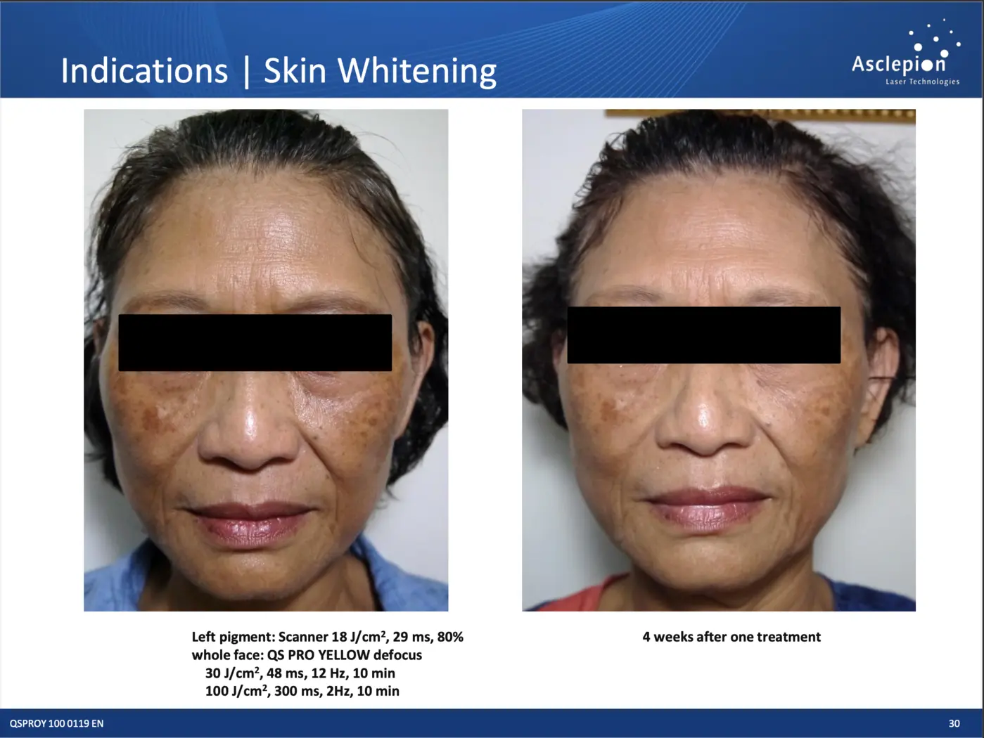 Before and after reference for a Byootee QuadroStar treatment plan