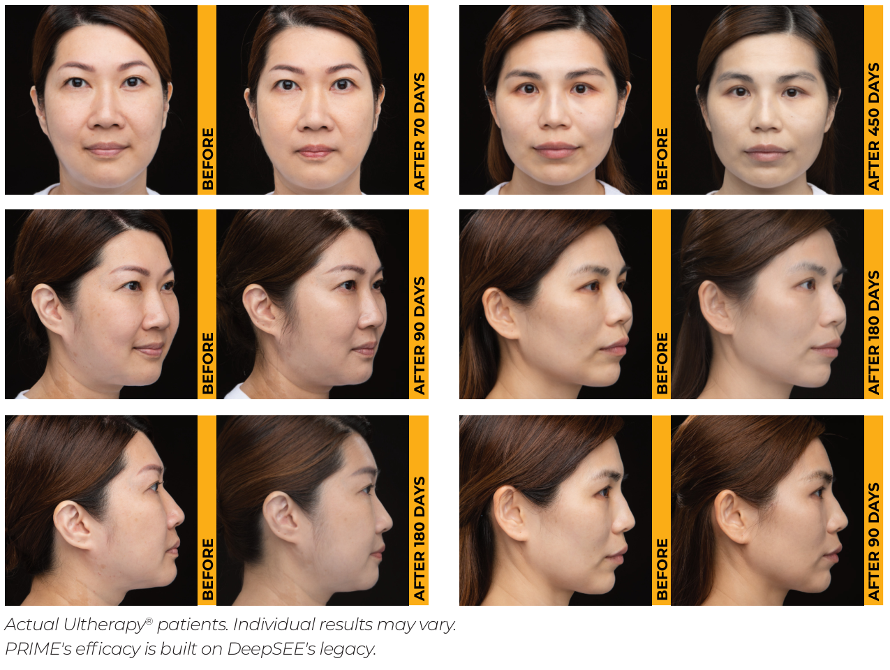 Six manufacturer-supplied Ultherapy before-and-after comparisons, retaining the original treatment time labels